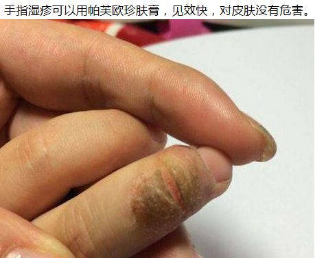 手指皲裂湿疹了解症状有效预防湿疹的方法