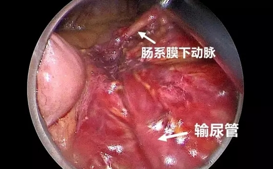 直肠癌肛门图片 肠道图片