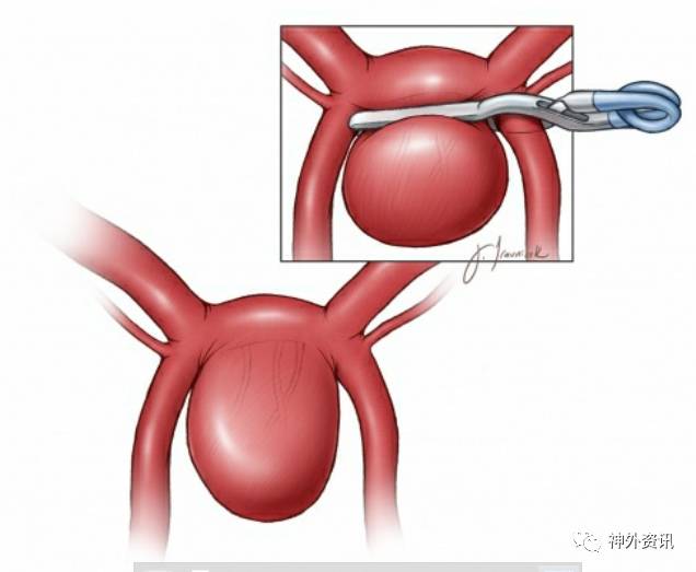 前交通动脉瘤手术要点theneurosurgicalatlas全文翻译