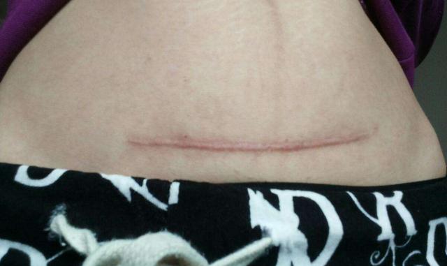 剖腹产后8个月伤口图图片