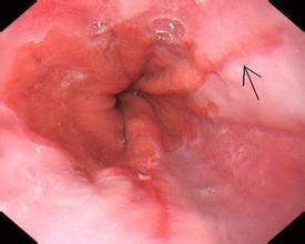 反流性食管炎喉咙堵图片