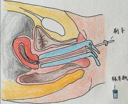 医生通过扩阴器打开阴道,可以非常容易暴露宫颈,通过特制的刷子在宫颈