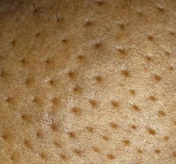 乳腺癌的皮肤凹陷图片图片