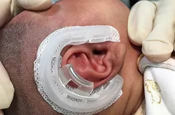 先天性耳廓畸形要尽早矫正!
