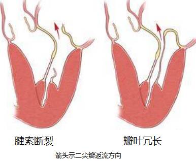 著名心脏病学者john brereton barlow基于心脏造影的观察于1966描述的