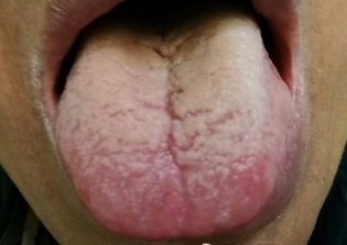 舌头肝郁线图片图片