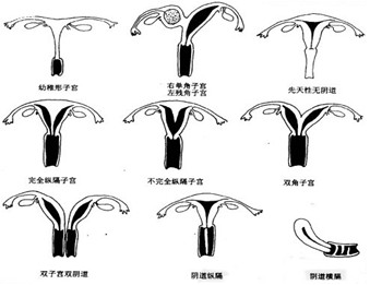 子宫畸形症状包括三类:既纵膈子宫,双角子宫,双子宫