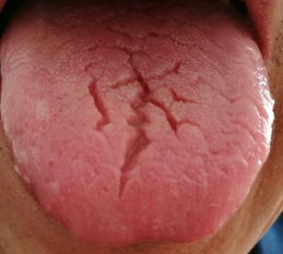 乙肝病毒舌头图片图片