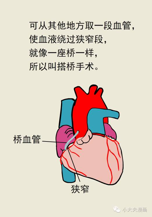 心脏搭桥示意图图片
