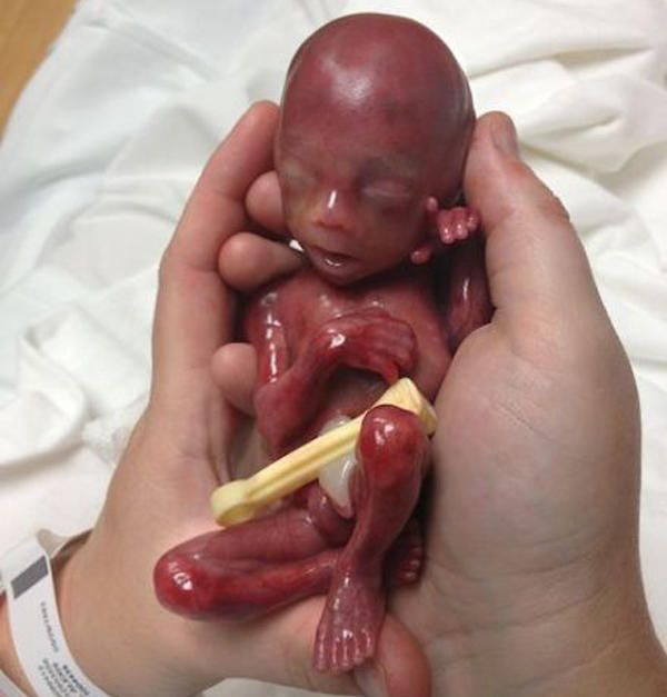 24周胎儿真人图片图片