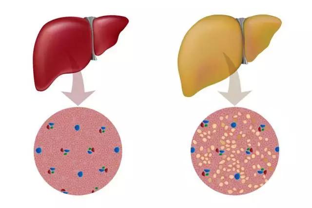 脂肪肝是怎麼來的?患病後會有哪些症狀?
