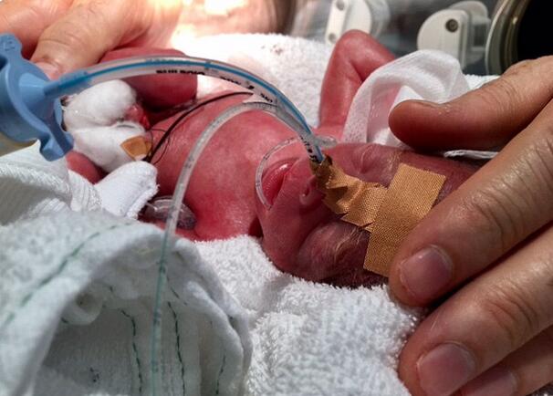 超坚强澳大利亚奇迹宝宝早产超15周仅639克