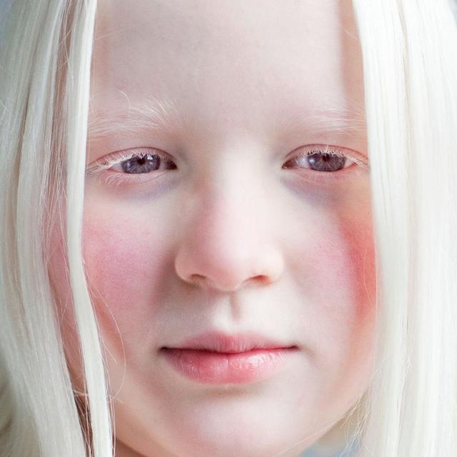 健康 白化病(albinism)是一种较常见的皮肤及其附属器官黑色素缺乏所
