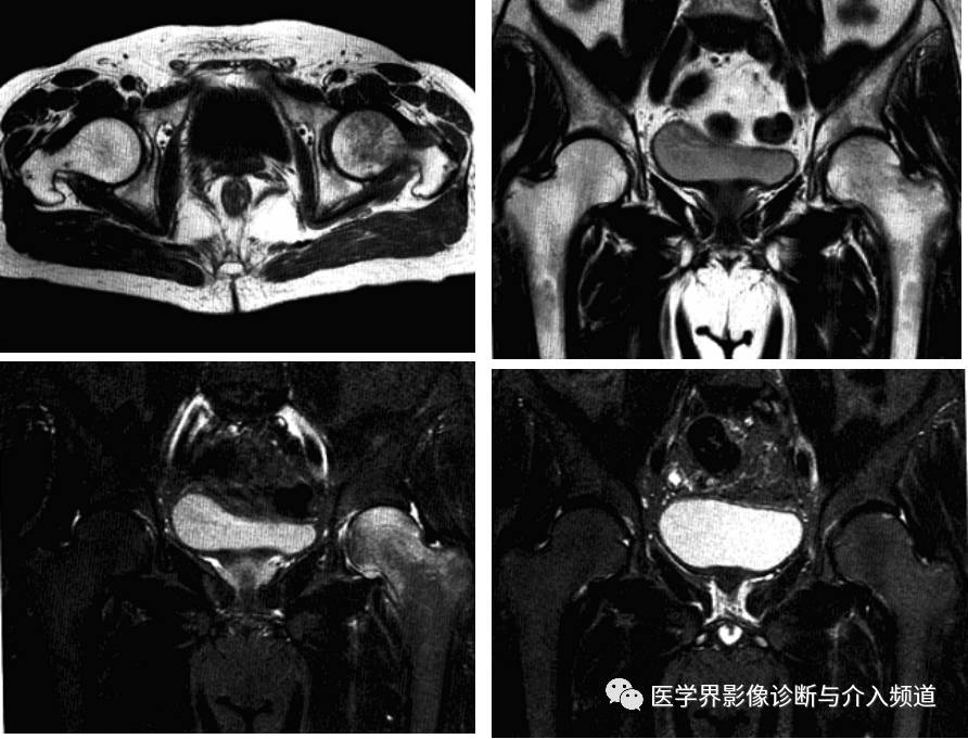 厉害了12种髋关节病变的影像鉴别诊断
