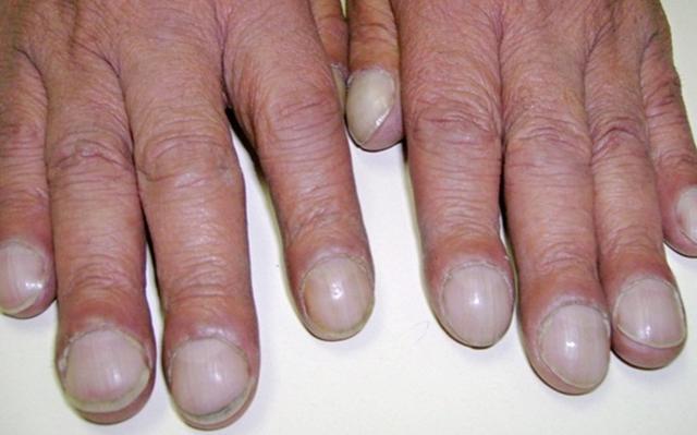肺癌的早期常见症状可能还会出现杵状指,是指与趾第一节变得肥大,指甲