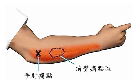 胳膊肘骨头突出图片