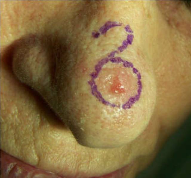 几种基底细胞癌的皮损及皮肤镜表现