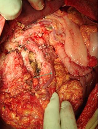 胰腺癌早期图片
