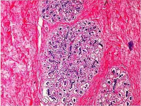 乳腺导管扩张症临床表现可分为3期