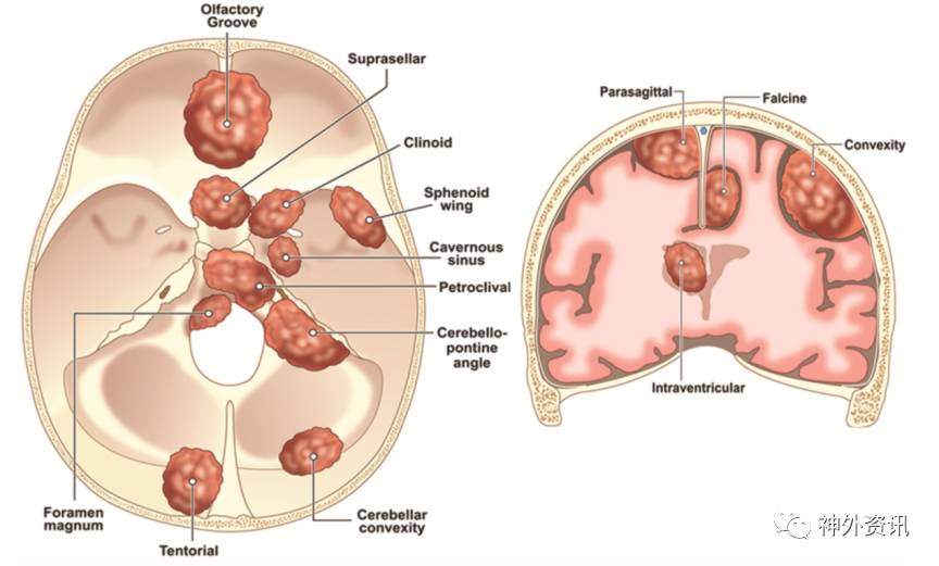 脑膜瘤位置图解图片