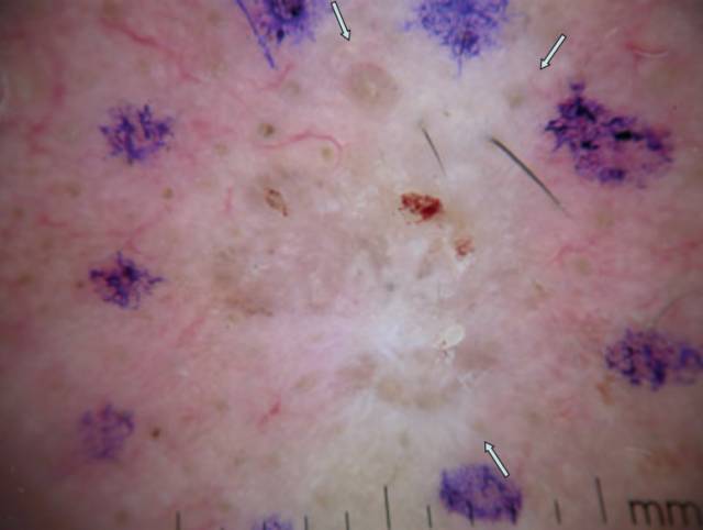 几种基底细胞癌的皮损及皮肤镜表现