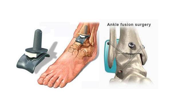 踝关节融合后走路图片图片