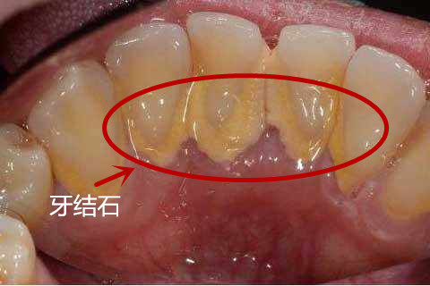 为什么牙结石集中在下牙内侧外侧最少