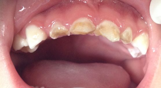 门牙龋齿各个阶段图片图片
