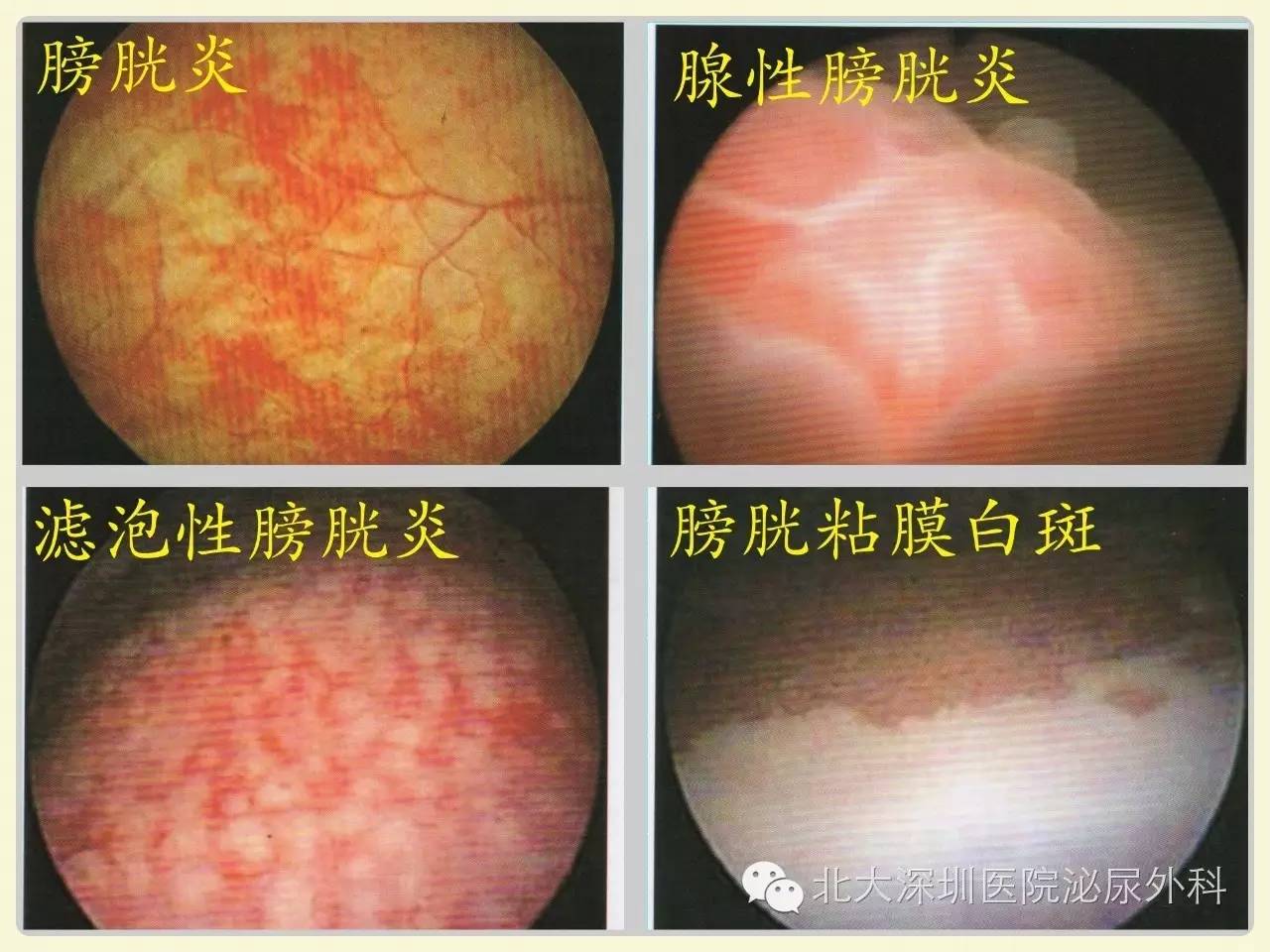 女性腺性膀胱炎图片图片