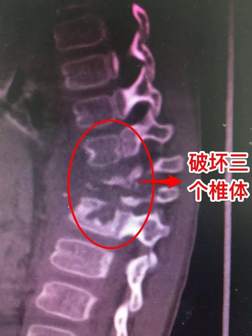 上海市一医院多学科合作为2岁骨结核患儿完成后凸畸形矫正术