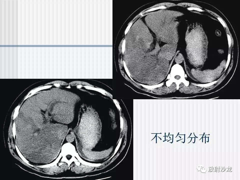 脂肪肝ct图图片