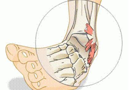 腳踝扭傷會有多長遠的影響?