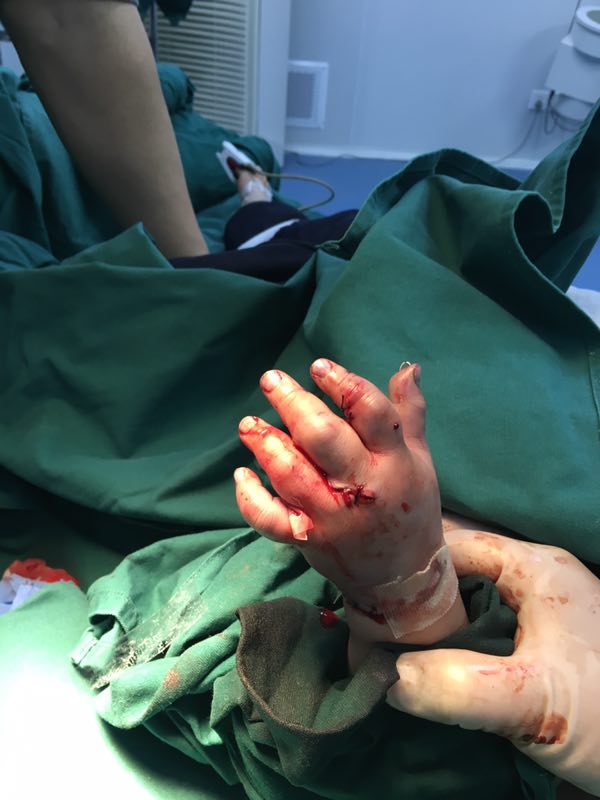 左手卷入压面机 两岁男童恐面临截肢