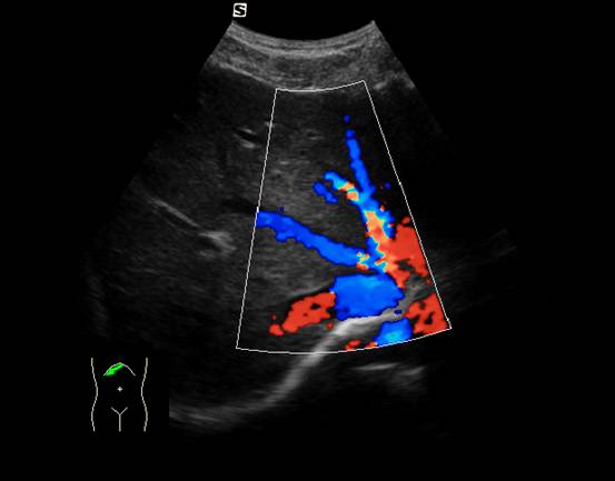 探头置于右侧肋缘下,探头标记朝向患者右下方,显示肝静脉汇入下腔静脉