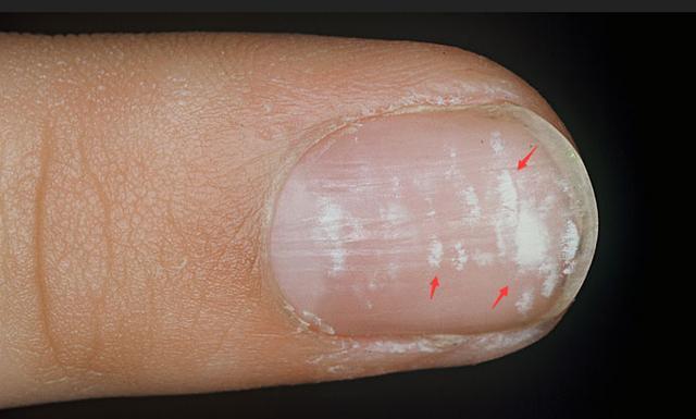 女性指甲上有白色斑点图片