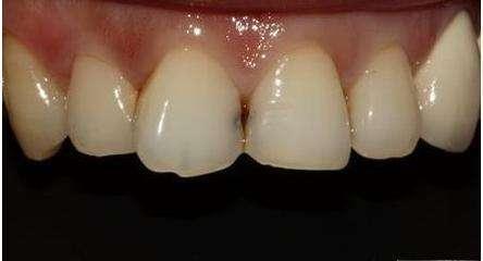 牙齿与牙龈缝处发黑图片