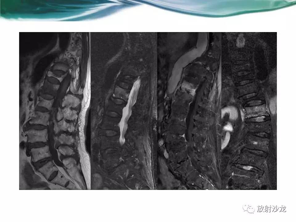 脊柱常见肿瘤及肿瘤样病变 的影像学表现