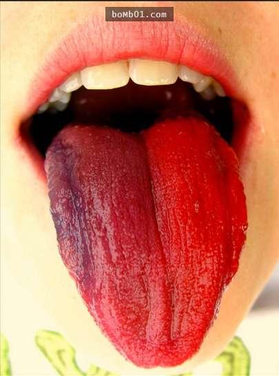 ▼鲜红色:美国俄亥俄州克利夫兰诊所的一项研究表明,鲜红色的舌头是
