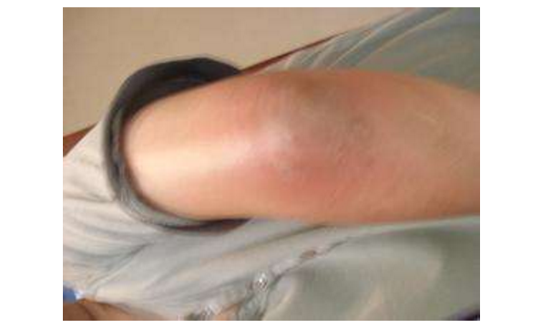 手肘骨膜炎的症状图片图片