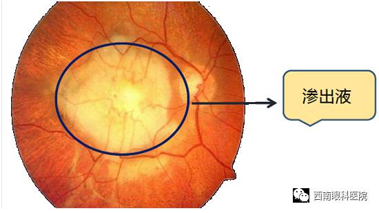 科普认知篇 什么是黄斑变性?