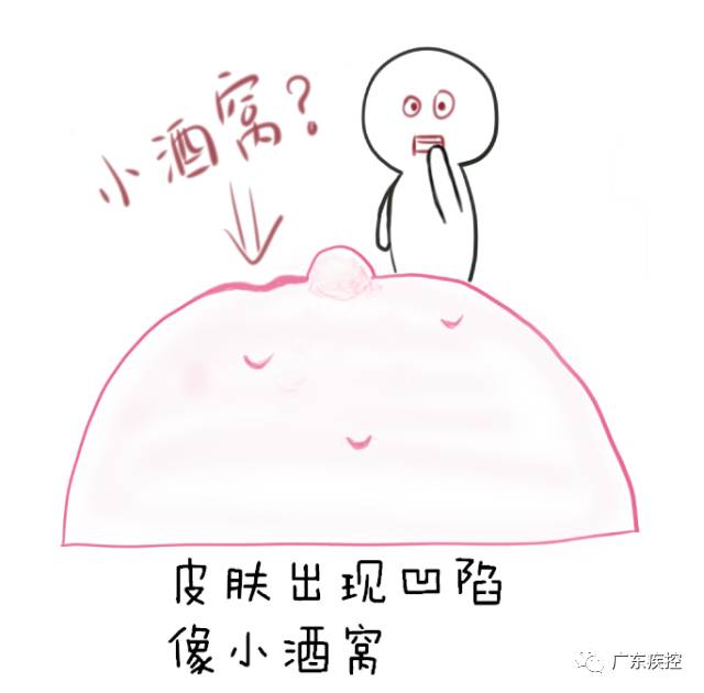 乳房酒窝这是乳腺癌的最常见表现