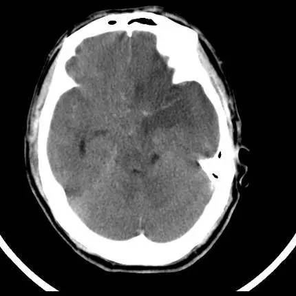 腦梗死的5大ct徵象