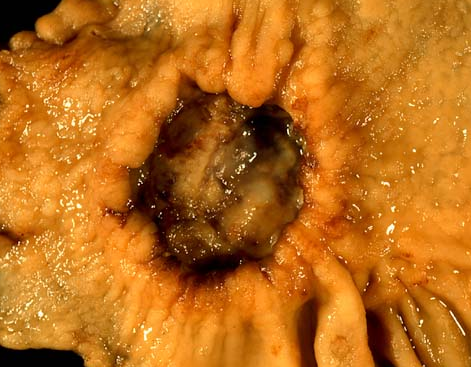 胃溃疡癌变图片图片