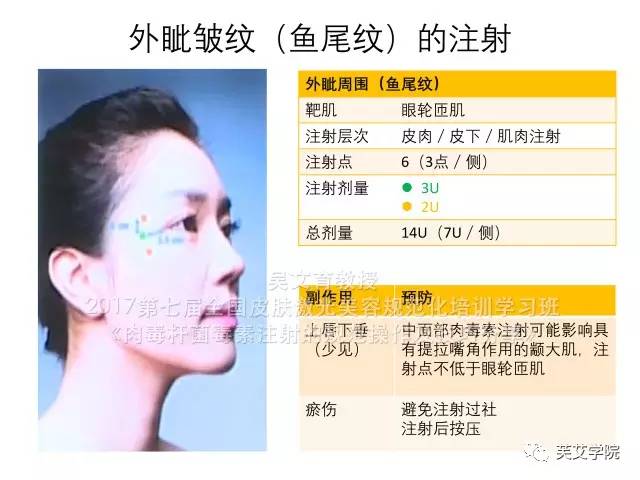 吴文育教授最新肉毒毒素治疗指南干货查看专家完整视频请登录wwwphi