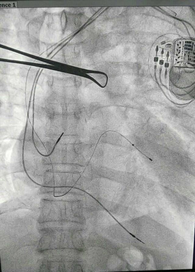 三腔起搏器 植入图片