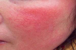 为什么毛细血管扩张会导致面部潮红?