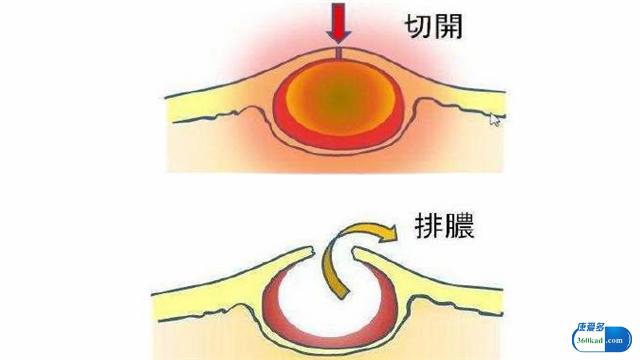 4,其他:腫瘤/寄生蟲大家先不要自己嚇自己,這些情況非常非常少見.