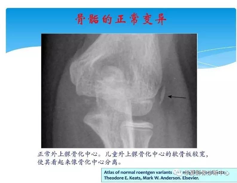 儿童肘关节骨化中心生理及变异