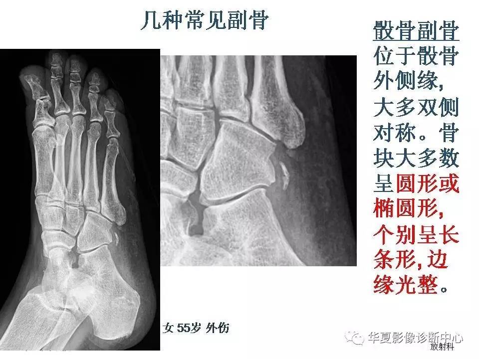 籽骨,副骨及永存骨骺,请别再误诊!