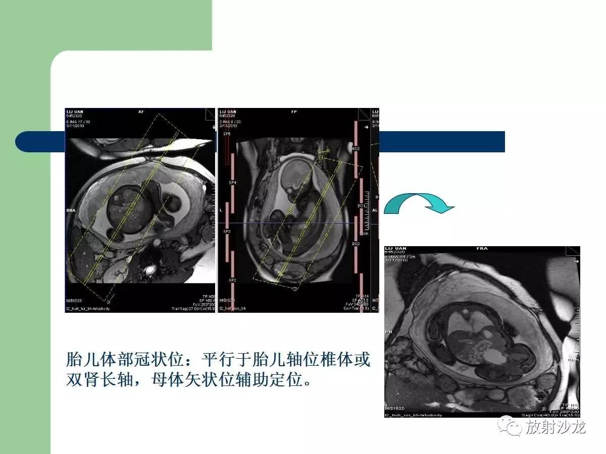 收藏| 胎兒核磁共振成像技術
